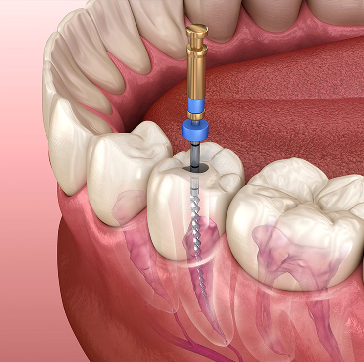 Root Canal Treatment